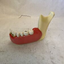 Vintage Dental Display Anatomical Model Lower Jaw Tooth Receding Gums picture